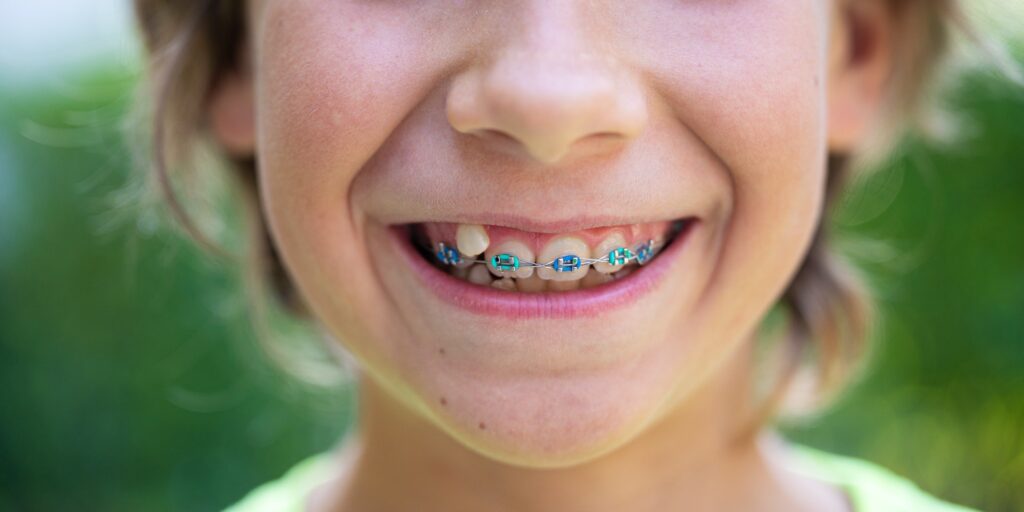 Child with dental braces