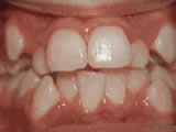 crowding-of-the-teeth-before- Steven Sabatino Orthodontics