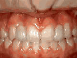 missing-lateral-incisors-after- Steven Sabatino Orthodontics
