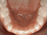 non-braces-treatment-after- Steven Sabatino Orthodontics
