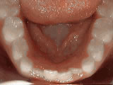 non-braces-treatment-before- Steven Sabatino Orthodontics