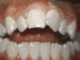openbite-before- Steven Sabatino Orthodontics