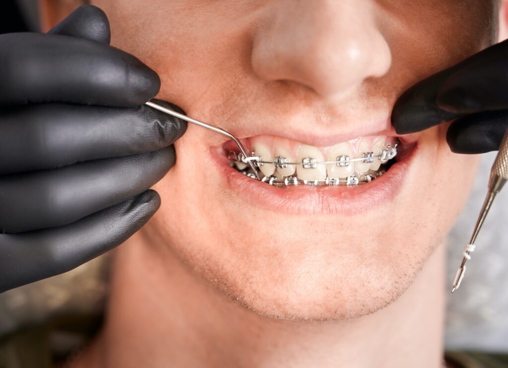 Orthodontist placing rubber bands on male patient braces.