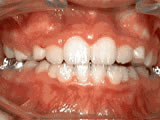 phase-1-after- Steven Sabatino Orthodontics