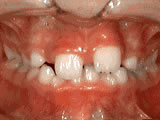 phase-1-before - Steven Sabatino Orthodontics