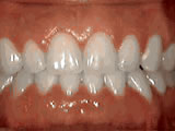 spacing-of-teeth-after- Steven Sabatino Orthodontics