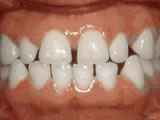 spacing-of-teeth-before- Steven Sabatino Orthodontics