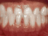 underbite-before- Steven Sabatino Orthodontics